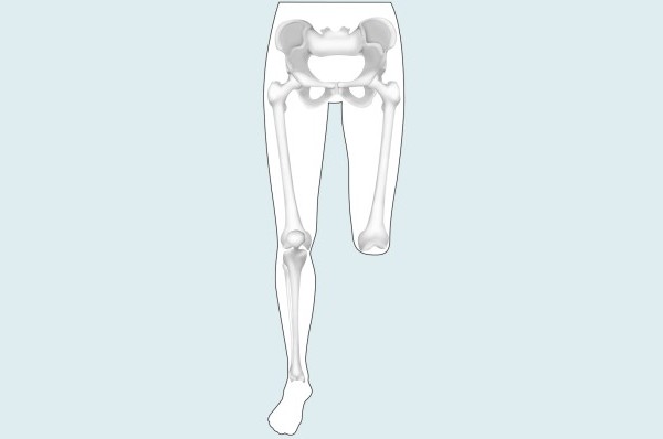 PROTESIS DESARTICULACIÓN RODILLA