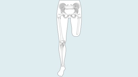 PROTESIS FEMORAL